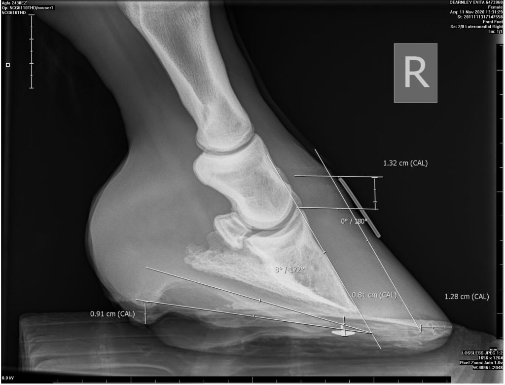 Photo of an X-ray of the right fore hoof showing 1.32cm of distal descent and 8º of rotation. You can also see that the sole is thin, as it is 0.91cm.