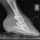 Photo of an X-ray of the right fore hoof showing 1.32cm of distal descent and 8º of rotation. You can also see that the sole is thin, as it is 0.91cm.